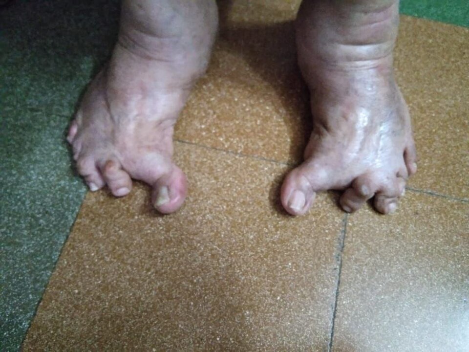 Flaring of Toes